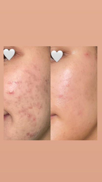 CLEAR CREME | Anti-Akne Balsam
