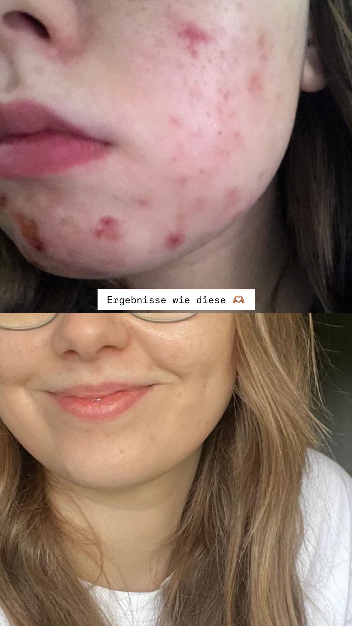 CLEAR CREME | Anti-Akne Balsam