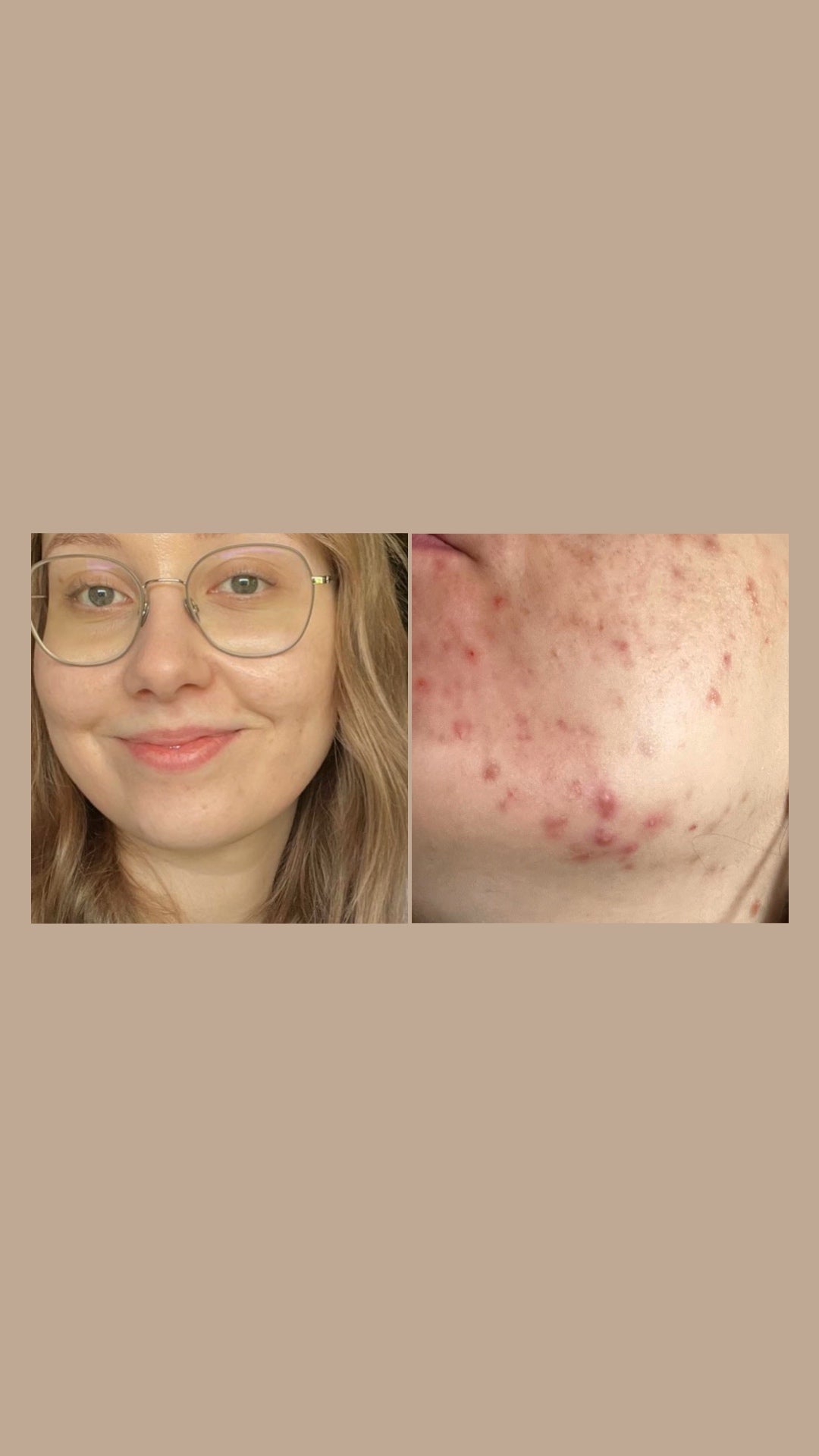 CLEAR CREME | Anti-Akne Balsam