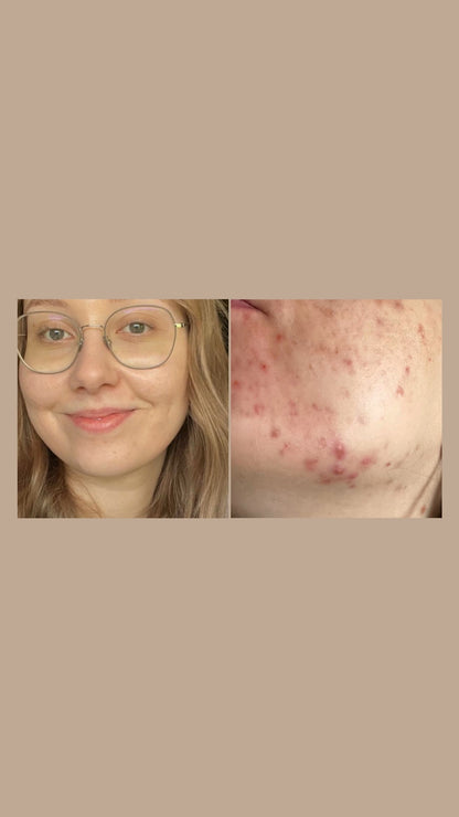 CLEAR CREME | Anti-Akne Balsam